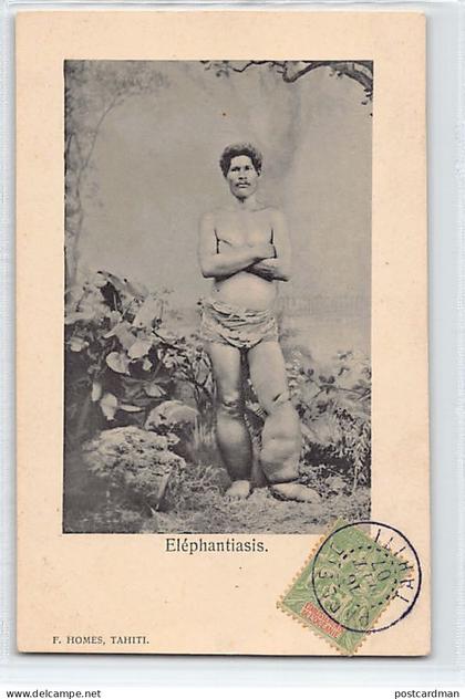Polynésie - Eléphantiasis - Ed. F. Homes