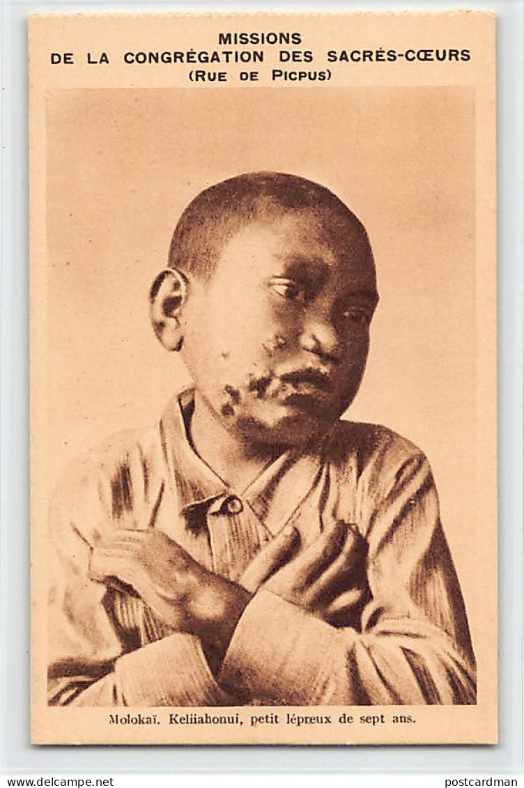 Hawaii - MOLOKAI - Leper Colony - Keliiahonoui, a 7-year-old leper - Publ. Missions of the Congregation of the Sacred He